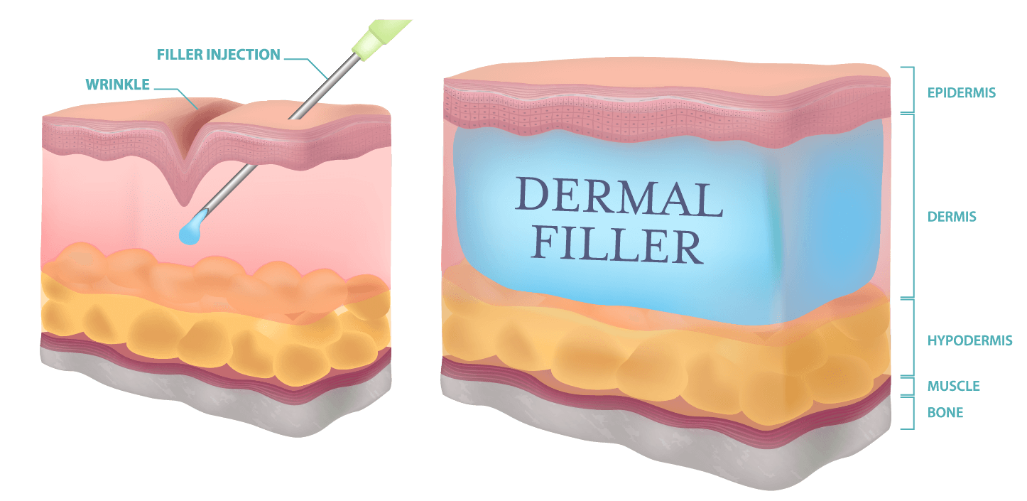 Dermal Fillers - Hartog Dental