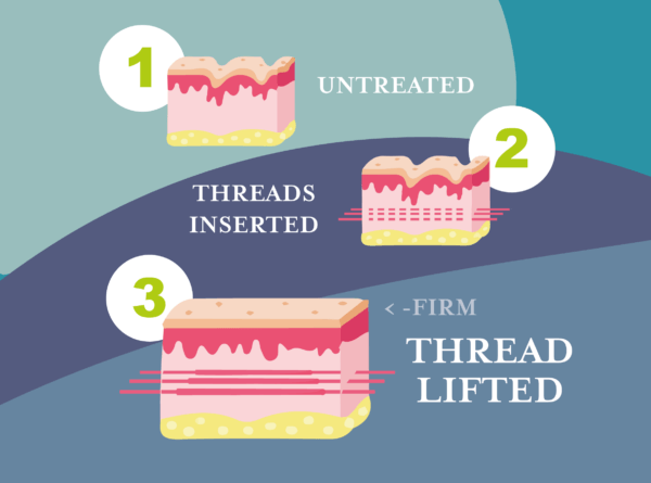 Hartog Dental - How Thread Lifts Work